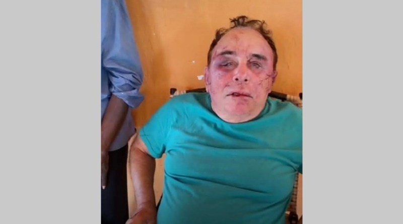 Candidato a prefeito de Santa Terezinha-PB, é brutalmente agredido por bandidos neste domingo