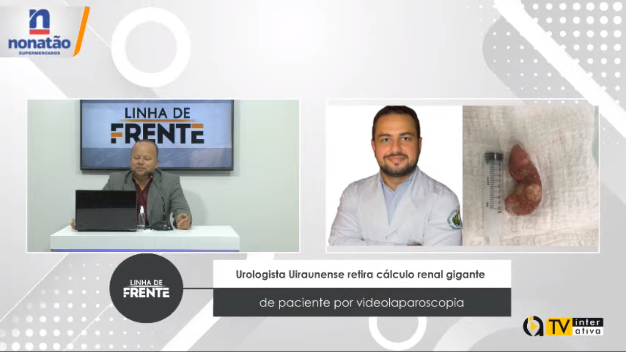 VEJA VÍDEO: Urologista Uiraunense retira cálculo renal gigante de paciente por videolaparoscopia !