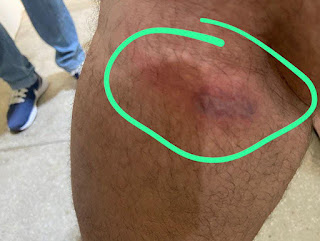 Homem é levado ao hospital após ser picado por aranha no RN