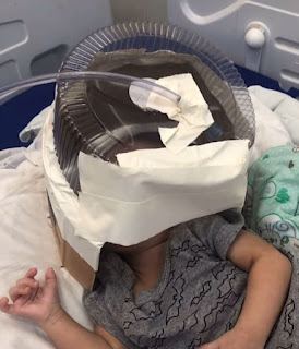  Morre bebê que usou respirador feito com embalagem de bolo no RN