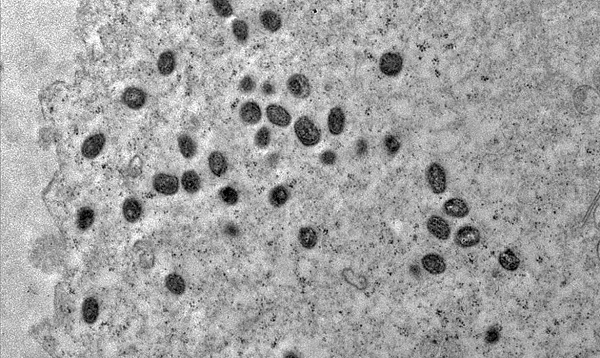 RN registra três novos casos de Monkeypox; pacientes estão em isolamento domiciliar